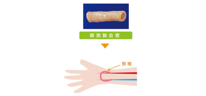 細胞製人工血管移植イメージ