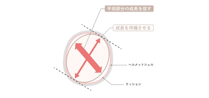 ベビーバンドでのヘルメット治療の方法(出典:株式会社Berry)